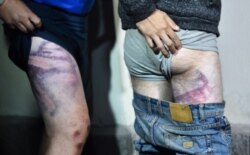 People detained during recent rallies of opposition supporters, who accuse Alexander Lukashenko of falsifying the polls in the presidential election, show their marks from beatings as they leave the Okrestina prison, in Minsk, Aug. 14, 2020.