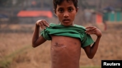 Mohammas Sohel (7 tahun), anak laki-laki pengungsi Rohingya, memperlihatkan bekas luka tembak di dadanya, di kamp penampungan pengungsi Kutupalong dekat Cox's Bazar, Bangladesh, 19 Desember 2017. (Foto: dok).