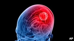 A new treatment uses the polio virus to fight cancer cells in the brain. (AP) 