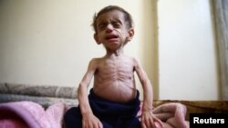 Kondisi seorang balita Suriah berusia 2,5 tahun, Hala al-Nufi, yang menderita kelainan metabolis, semakin memburuk akibat kekurangan pasokan makanan di Ghouta Timur yang dikepung pasukan pemerintah (Foto: 25 Oktober 2017). 