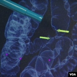 Jika sel-sel tidak normal atau polip ditemukan selama berlangsungnya kolonoskopi dengan CT scan, kolonoskopi biasa dilakukan untuk mengangkat polip tersebut.