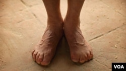 ნანგა პარბატის "წყევლა" - მესნერის ამპუტირებული თითები