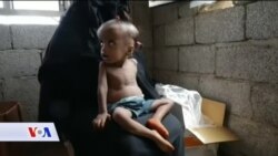 JEMEN: Neuhranjeno je više od 1.8 miliona djece mlađe od pet godina