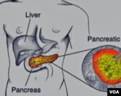 pancreatic cancer voa