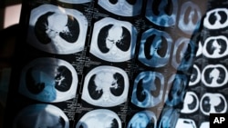 In this Thursday, Dec. 8, 2016 photo, Chinese doctor Peng Limei browses CT scans of lung cancer patients at the Jingdong Zhongmei private hospital in Yanjiao, China's Hebei Province. (AP Photo/Andy Wong)