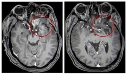 This combination of MRI images provided by the University of Alabama in April 2021 shows scans of a child with a brain tumor, before and after the treatment.