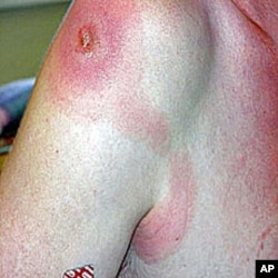 Lesion on shoulder, which is symptomatic of Sleeping Sickness