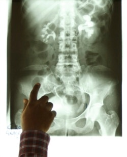 Hasil rontgen dari pasien yang menderita kanker kandung kemih menunjukkan adanya sel kanker. (Foto: REUTERS/Olivier Asselin)