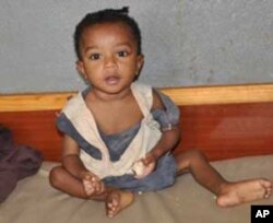 Malnourished child at Dill Hospital, southern Ethiopia