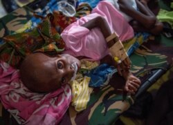 Seorang anak Papua yang menderita gizi buruk terbaring di ranjang rumah sakit untuk menjalani perawatan di Agats, ibu kota Kabupaten Asmat di Papua pada 26 Januari 2018. (Foto: AFP/Bay Ismoyo)