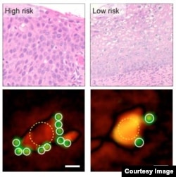 By counting the number of microbeads bound to cancerous cells (lower images), the D3 system categorizes high- and low-risk cervical biopsy samples as well as traditional pathology (upper images). (Massachusetts General Hospital)