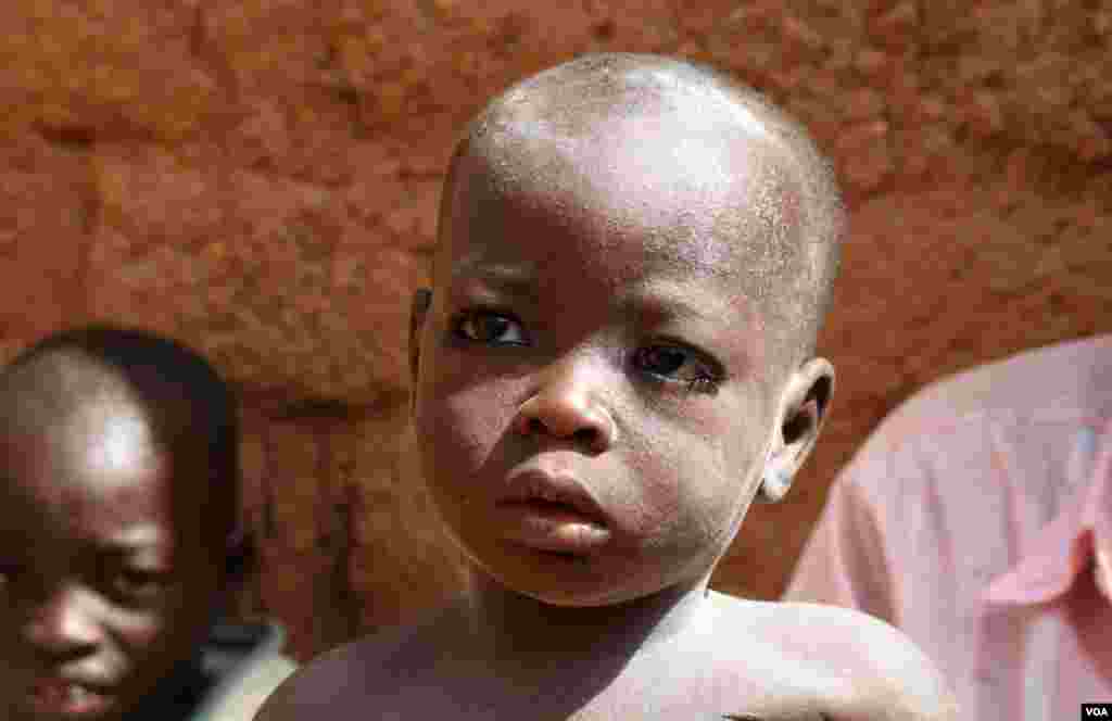 This one-year-old child began convulsing in late August. His father traveled six hours on a motorcycle to the nearest hospital. Aid workers say as long he lives in Bagega, a village contaminated by lead, the baby cannot be cured. (H. Murdock for VOA)