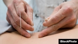 Treatment by acupuncture