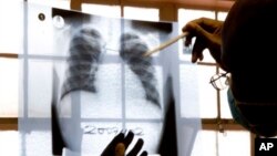 FILE - A doctor examines chest X-rays at a tuberculosis clinic in Cape Town, South Africa. 