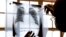 FILE - A doctor examines chest X-rays at a tuberculosis clinic in Gugulethu, Cape Town, South Africa, Jan. 17, 2014. 