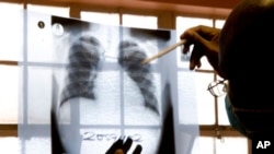 FILE - A doctor examines chest X-rays at a tuberculosis clinic in Gugulethu, Cape Town, South Africa.