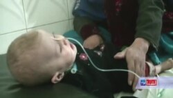 افزایش بی سابقه سوی تغذیه کودکان در غزنی