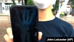 In this October 7, 2019, photo, an organizer of an underground network of volunteer Hong Kong medics that are treating injured protesters shows an X-ray image on her mobile phone that revealed a fracture above the left wrist of a protester in Hong Kong.