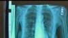 Early CT Scans Can Cut Lung Cancer Death Rate