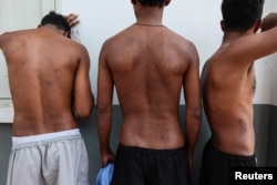 ภาพชาวเอธิโอเปียที่เป็นเหยื่อแก๊งคอลเซนเตอร์ในเมียนมาหลังถูกหลอก จับไปขังและบังคับให้ทำงานที่ศูนย์ในเมียนมา ก่อนจะได้รับความช่วยเหลือและพาตัวมาไทยเมื่อ 12 ก.พ. 2568 เปิดแผลและร่อยรอยการบาดเจ็บจากการถูกทำร้ายเมื่อทำงานไม่ถึงเป้า