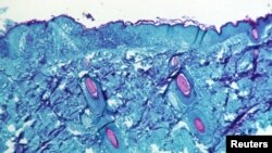 원숭이두창에 감염된 피부 조직. 