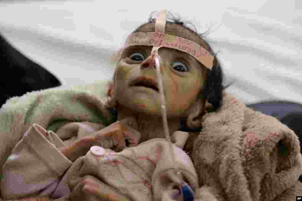 Infant Udai Faisal, who suffered from acute malnutrition, is hospitalized at Al-Sabeen Hospital in Sana&#39;a, Yemen, March 22, 2016. Udai died on March 24. Hunger has been the most horrific consequence of Yemen&rsquo;s conflict and has spiraled since Saudi Arabia and its allies, backed by the U.S., launched a campaign of airstrikes and a naval blockade a year ago.