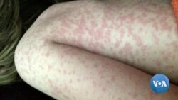 Measles on the Rise Around the World