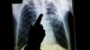 결핵 환자의 X-레이 사진. (자료사진)