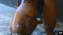 Elephantiasis Afflicts 120 Million in Africa, Asia